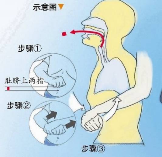 成人气管异物急救定位.jpeg