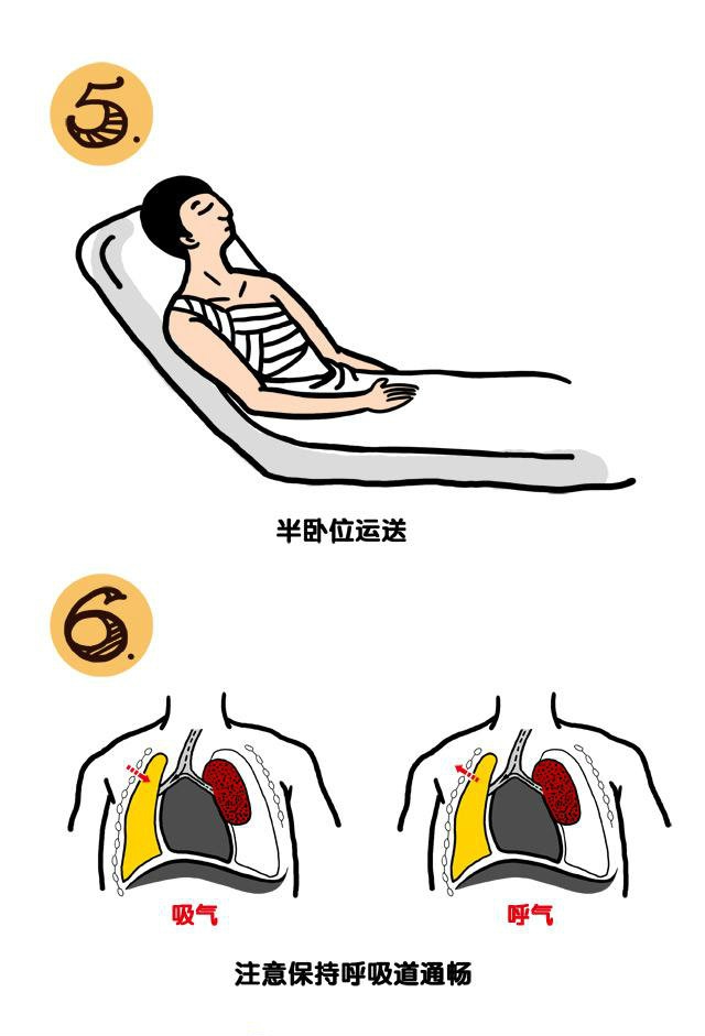 开放性气胸的现场急救3.jpg